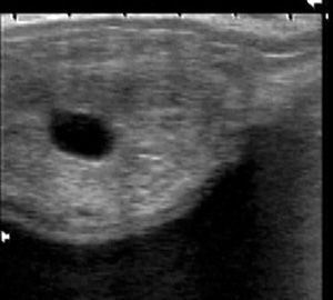 ultrasound image of a 12 mm cyst