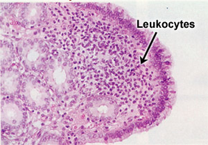 lymphocytes in the uterine epithelium showing acute inflamation